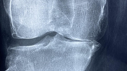 pixabay MD bone x-ray